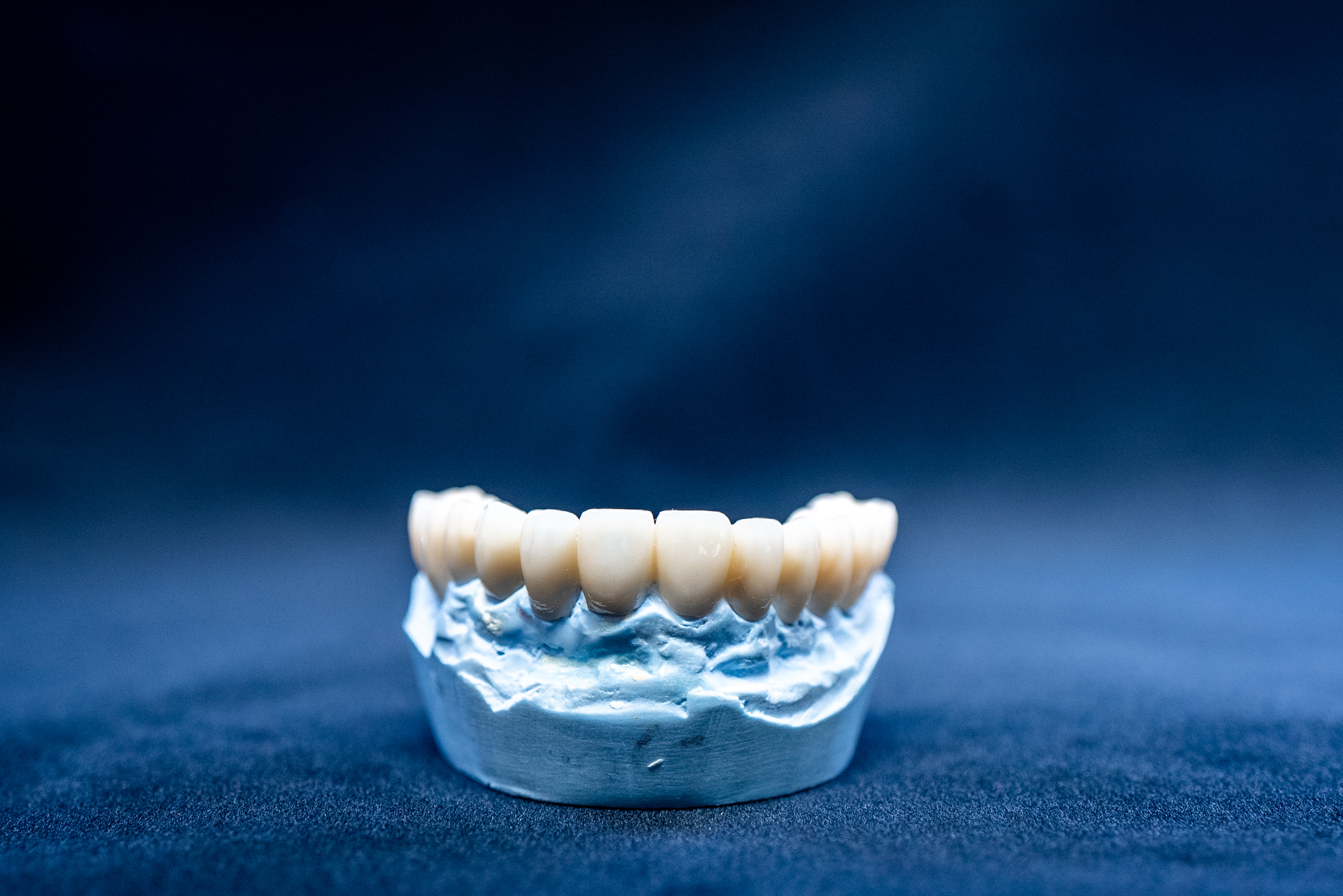Implant-supported bridge model showing how two implants can replace three or more missing teeth