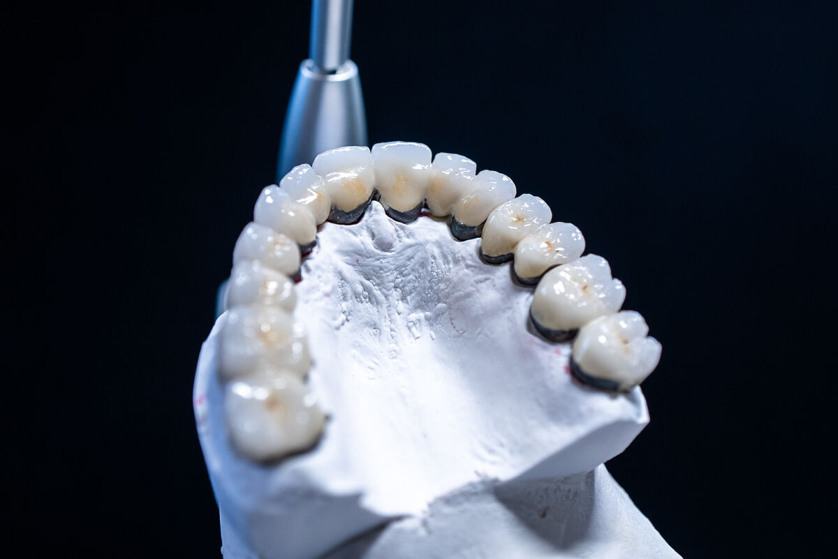 Single tooth dental implant restoration for Bethesda patients