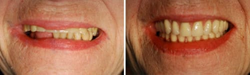 Before and after comparison showing transition from traditional dentures to implant-supported restoration