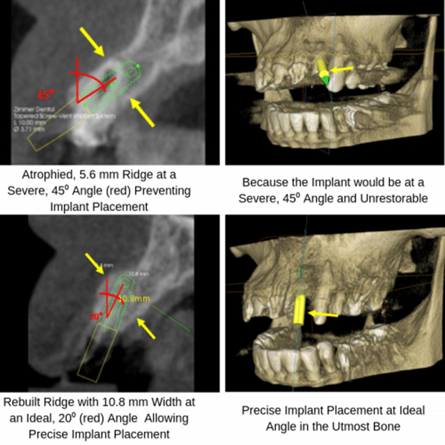 Bone grafting procedure to prepare jawbone for dental implant placement at Elite Prosthetic Dentistry
