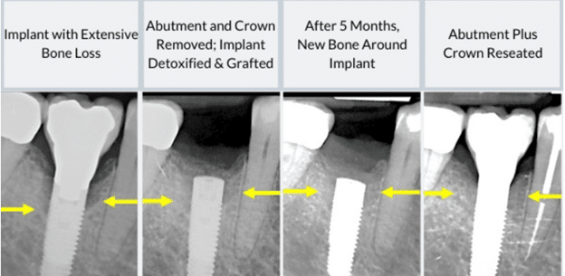 Diagnosis of a failing dental implant using advanced imaging at Elite Prosthetic Dentistry serving Bethesda