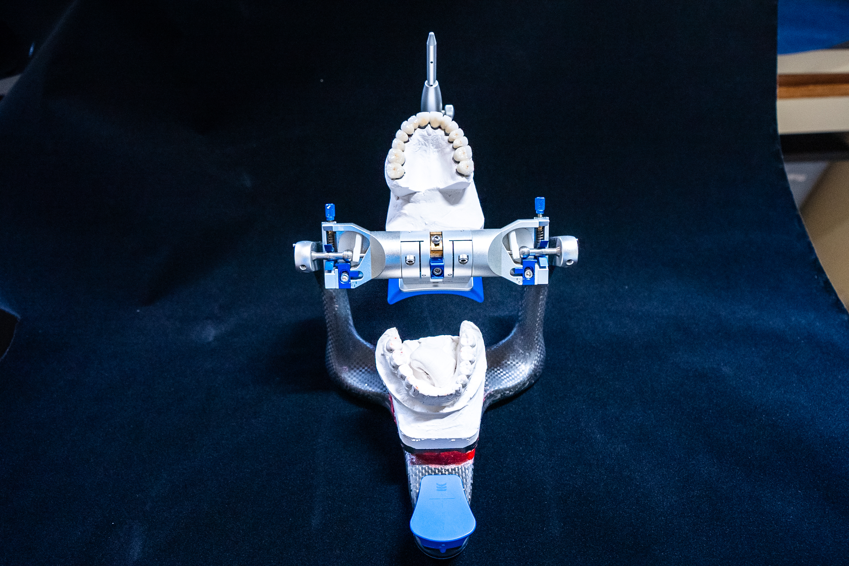 Full arch dental implant prosthetic model showing angled posterior implants for maximum bone engagement