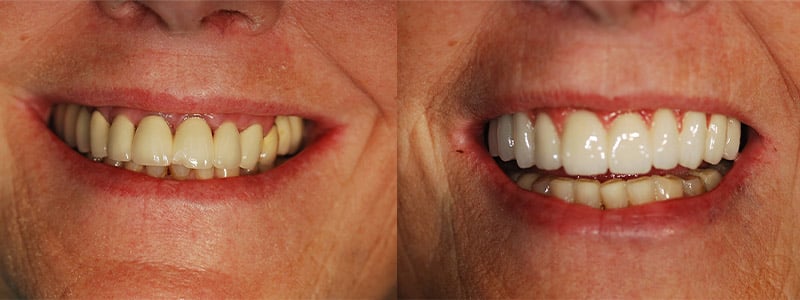 Full arch implant-supported reconstruction for patients missing many or all teeth in an arch