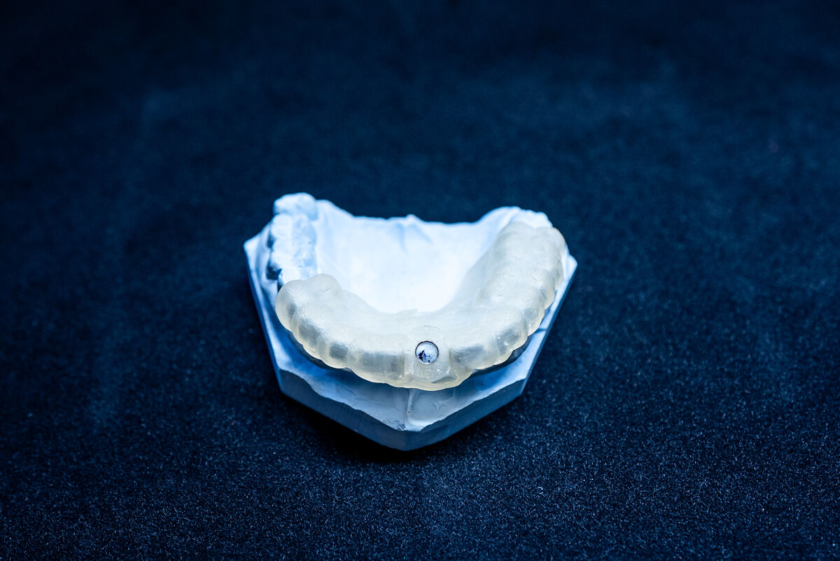 Full mouth dental implant model showing prosthetic restoration in Bethesda prosthodontics