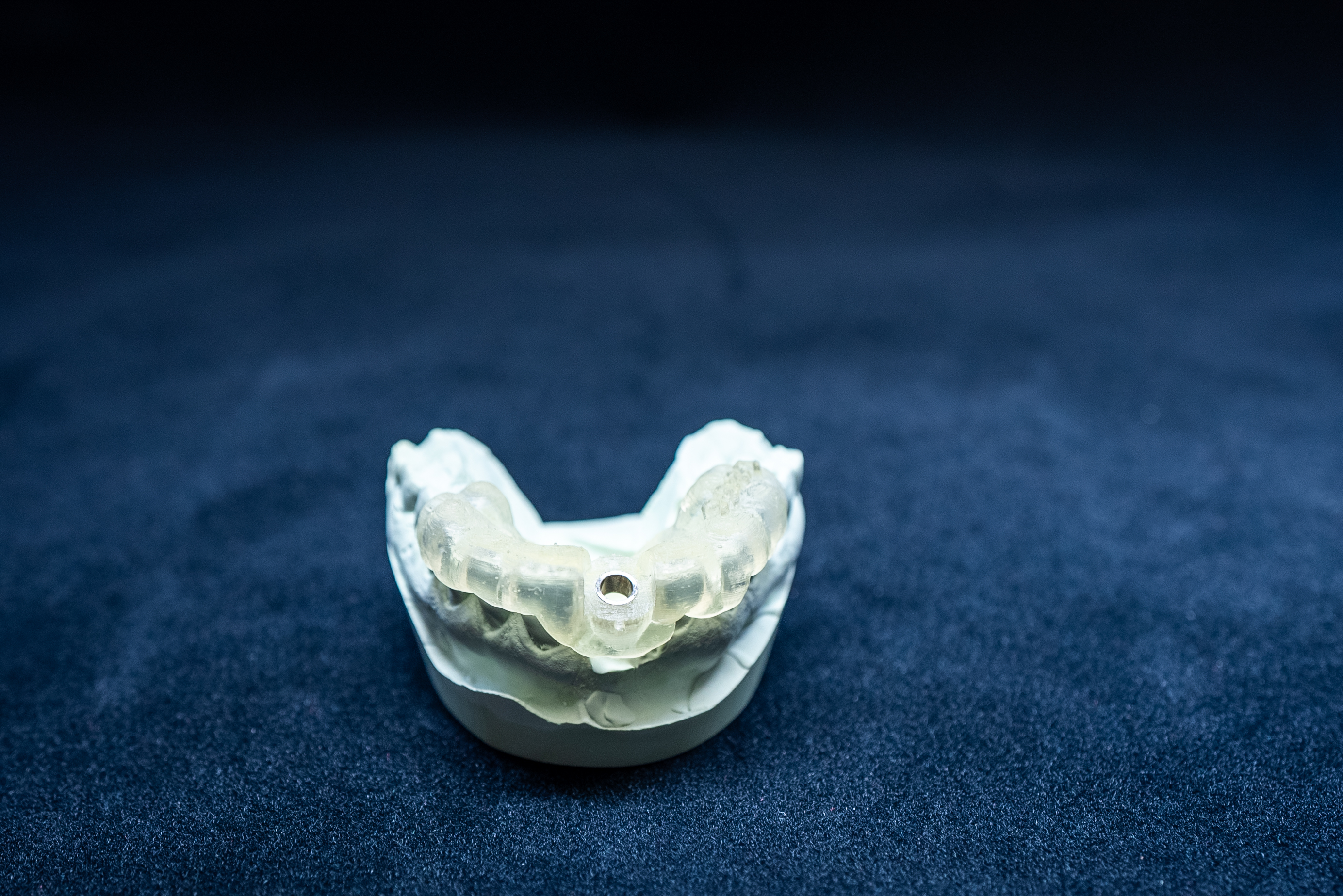 Dental implant crown restoration model showing independent support without affecting adjacent teeth