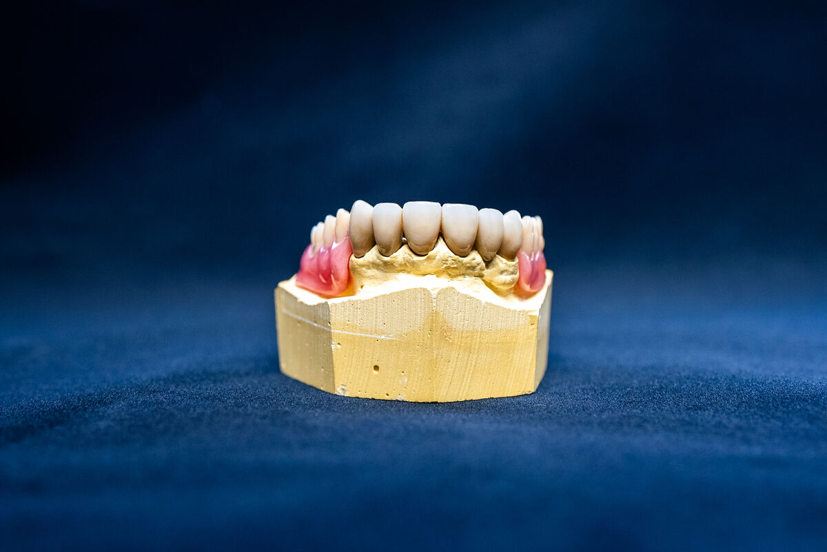 Single tooth implant restoration in Bethesda