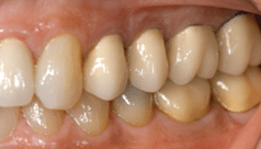 Example of a long-lasting dental implant crown that has served a patient for decades with proper care