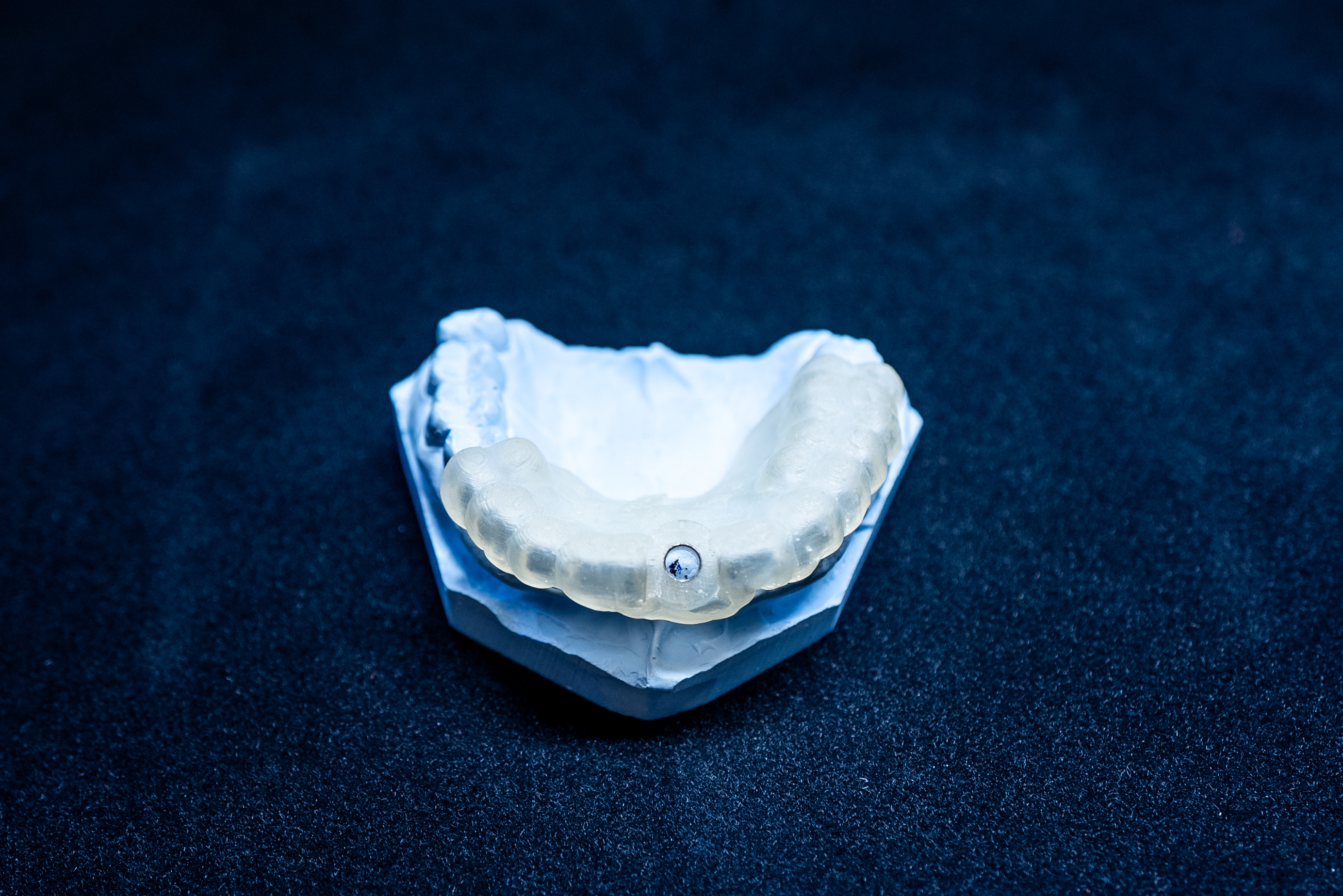 Traditional dental implant model showing robust titanium post for long-term stability in the jawbone