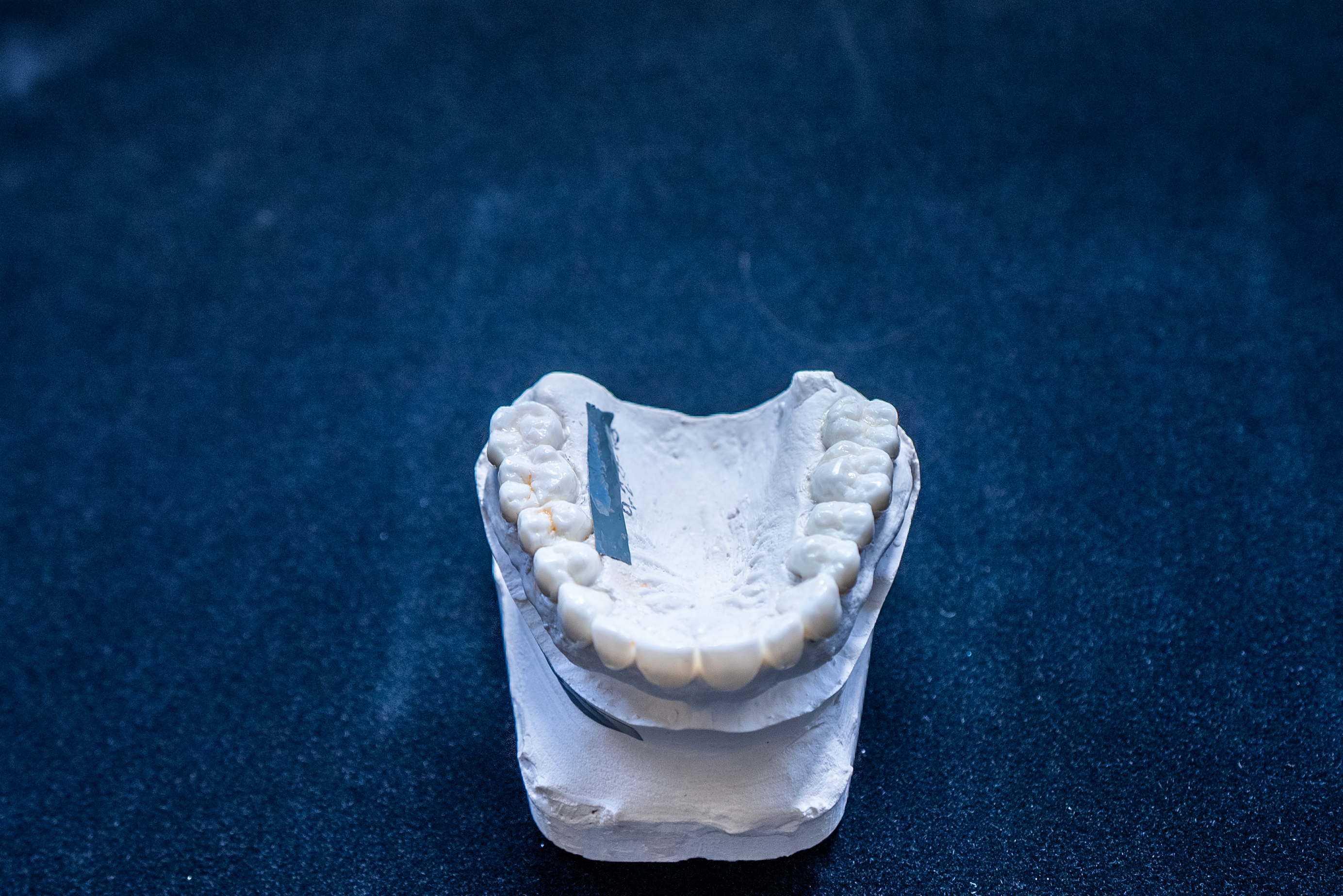 Zirconia and titanium dental implant restoration models showing different material options available at Elite Prosthetic Dentistry
